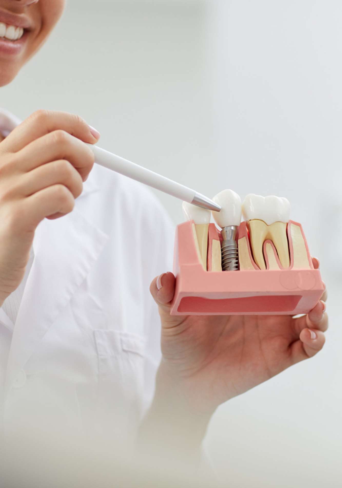 Dental implants