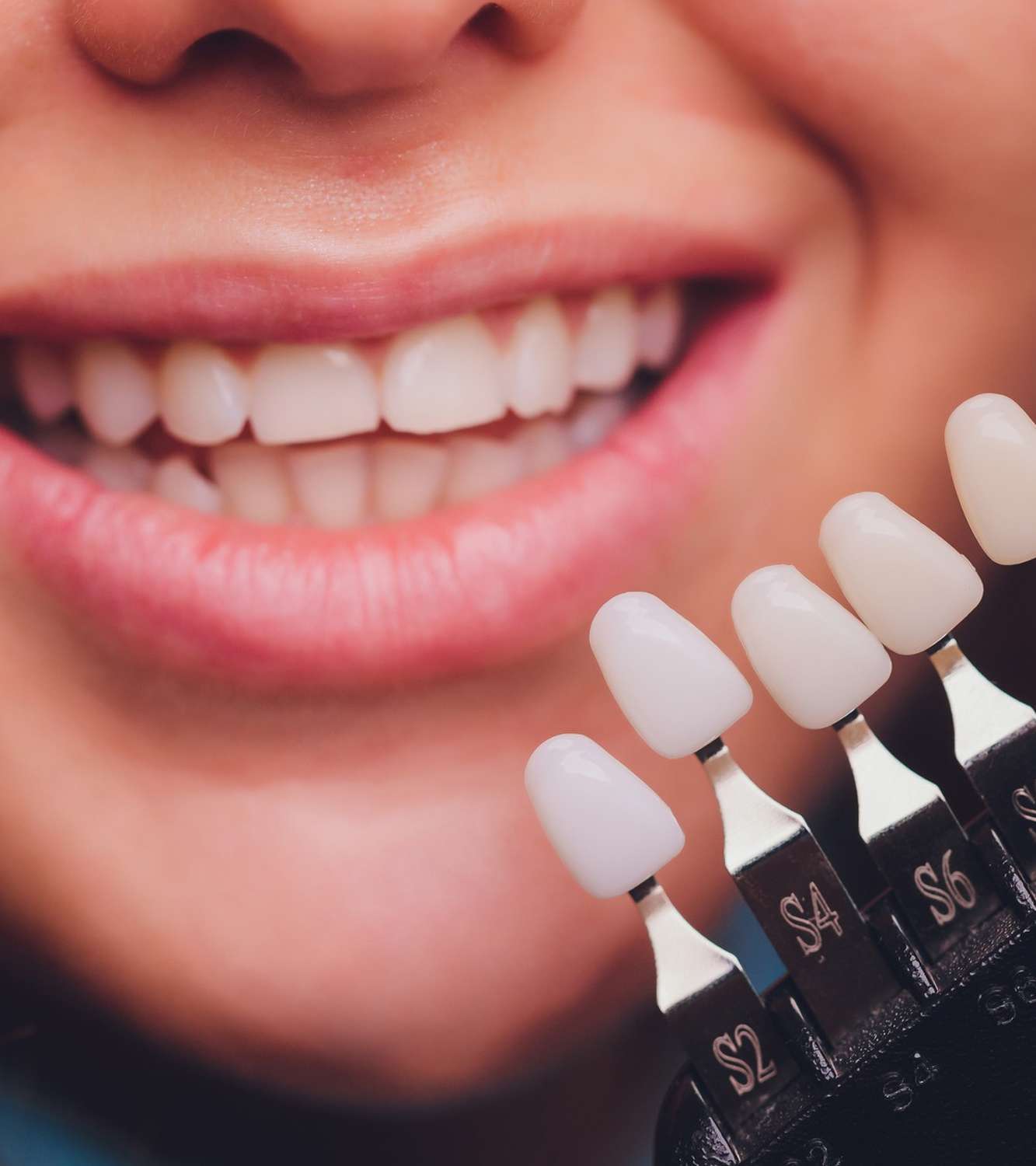 Porcelain veneers