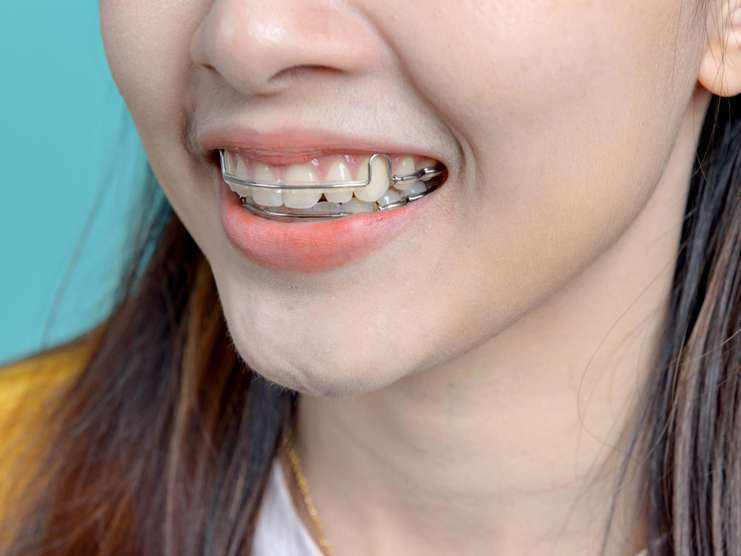 Two-phase orthodontic treatment