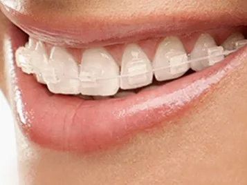 Nearly invisible ceramic brackets