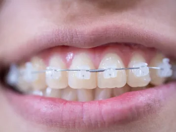 Ceramic braces treatment