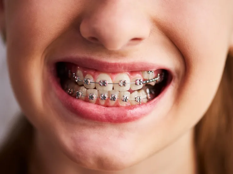 Orthodontics for adults