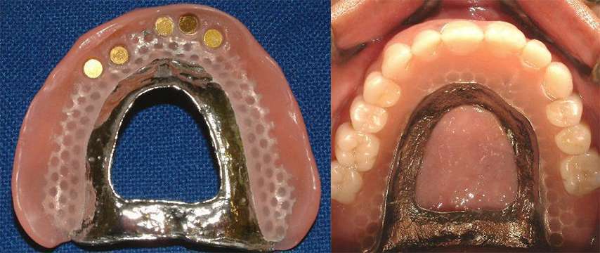 Complete dentures