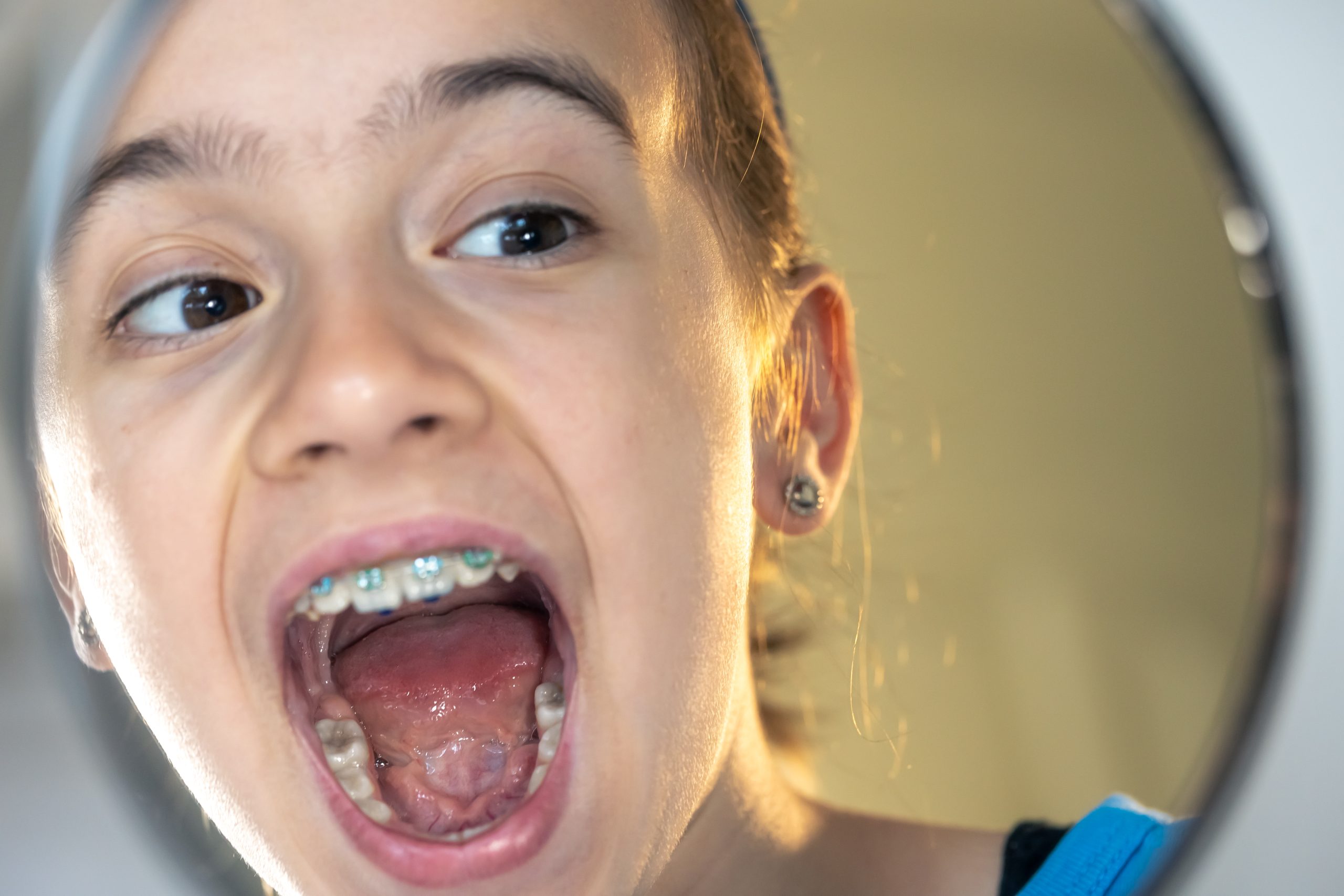 Worn Teeth Treatment in Turramurra