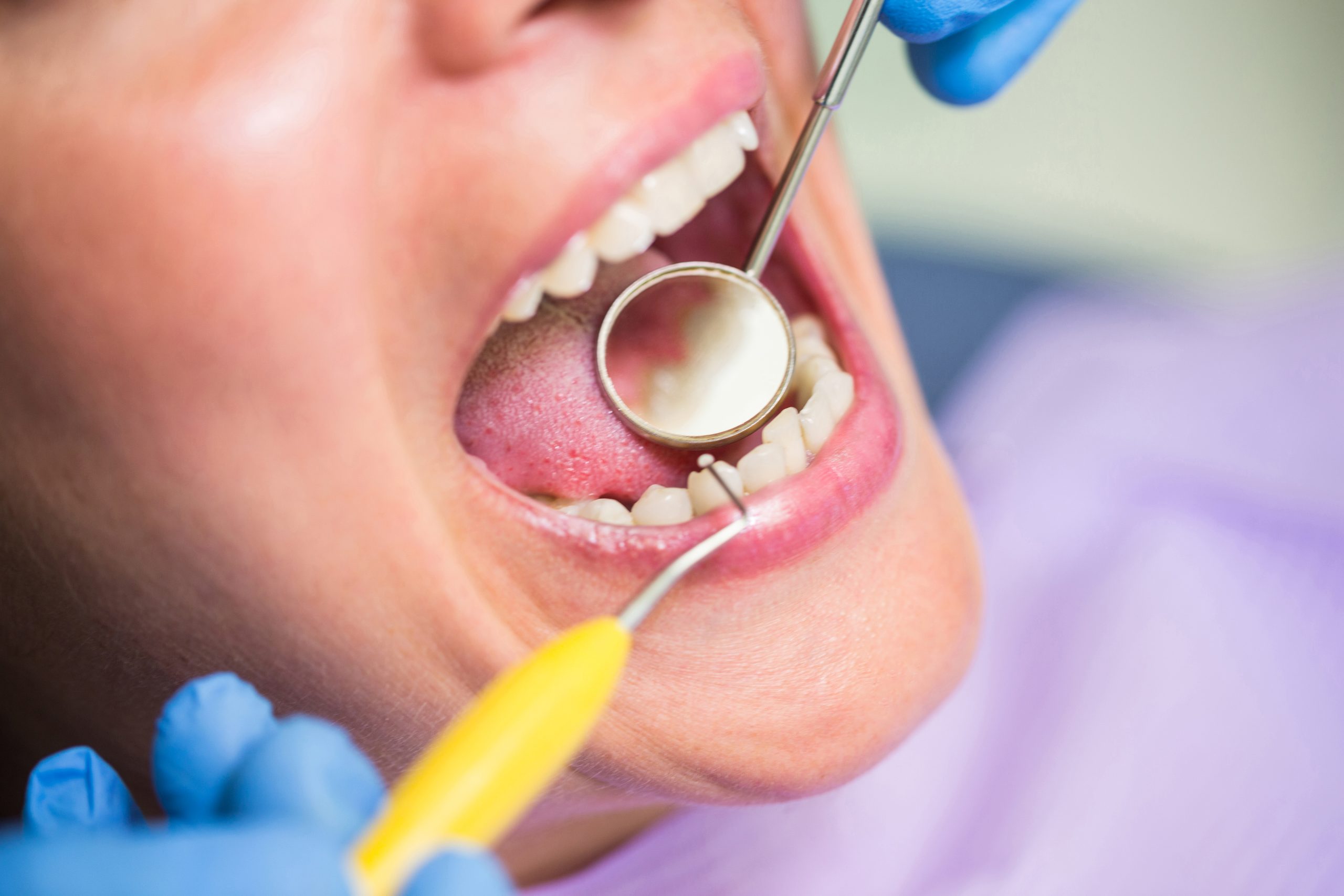 Chipped Tooth Repair in Turramurra