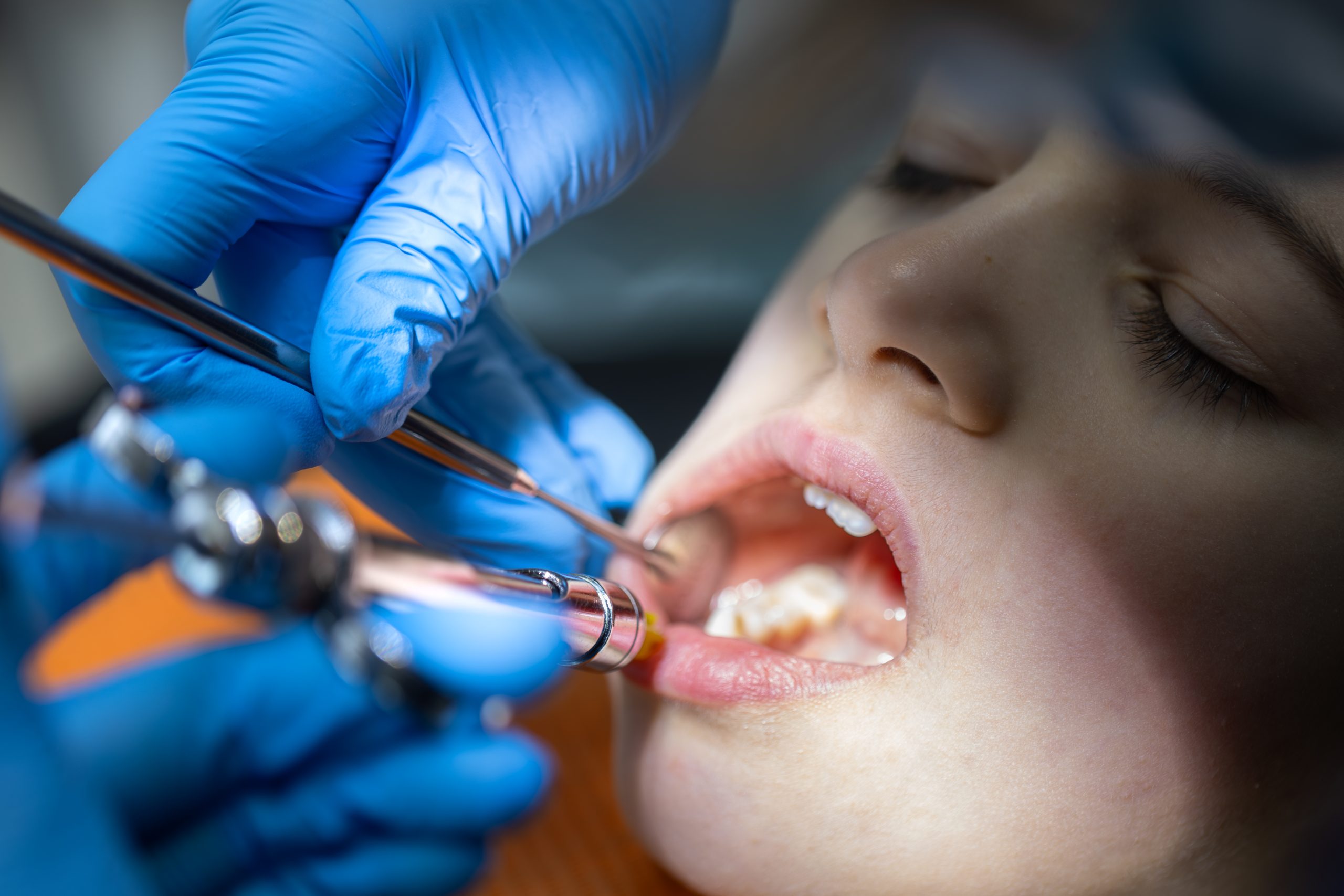 Cracked Tooth Syndrome Treatment in Turramurra