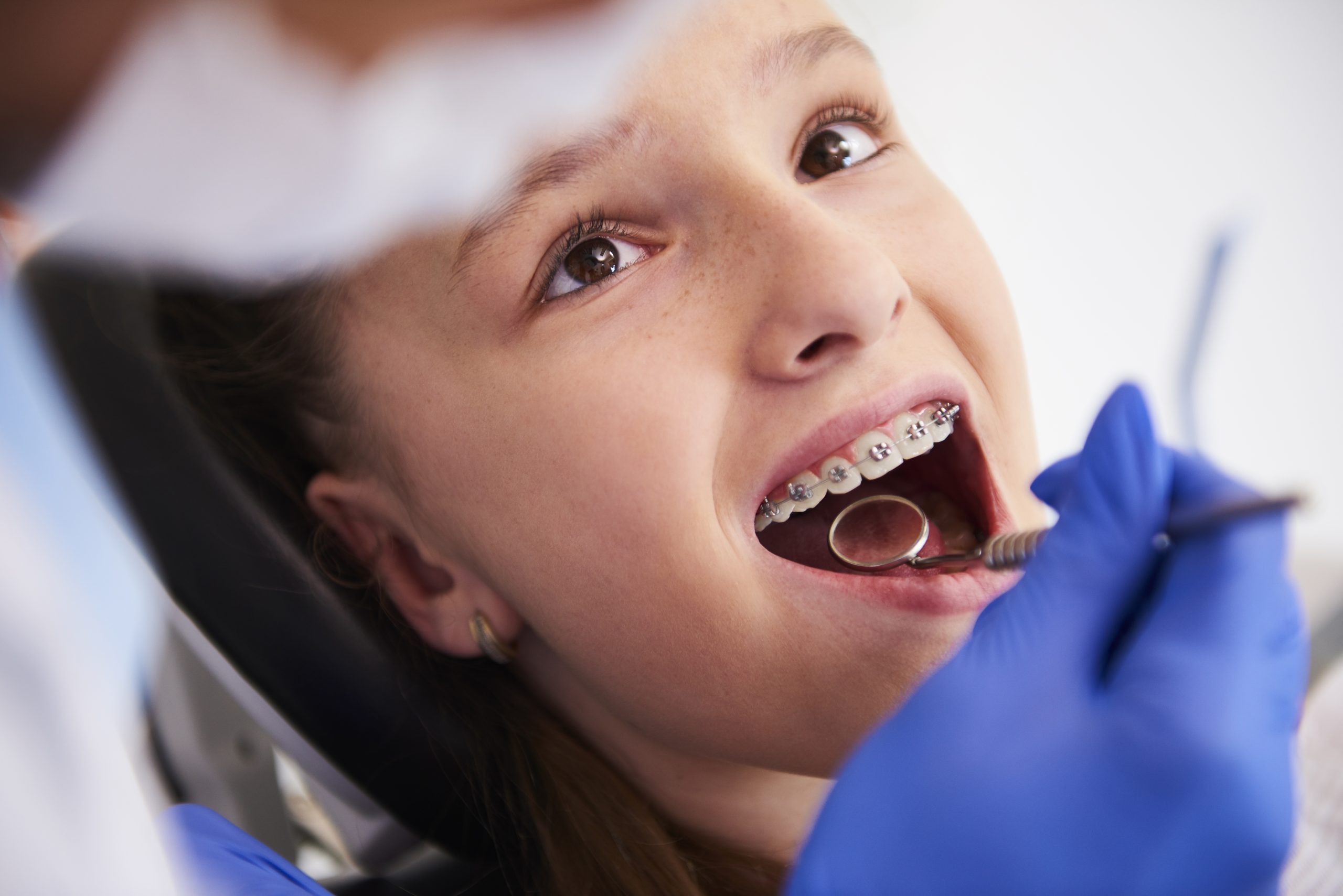 Lingual Braces Turramurra: Hidden Braces Behind Teeth