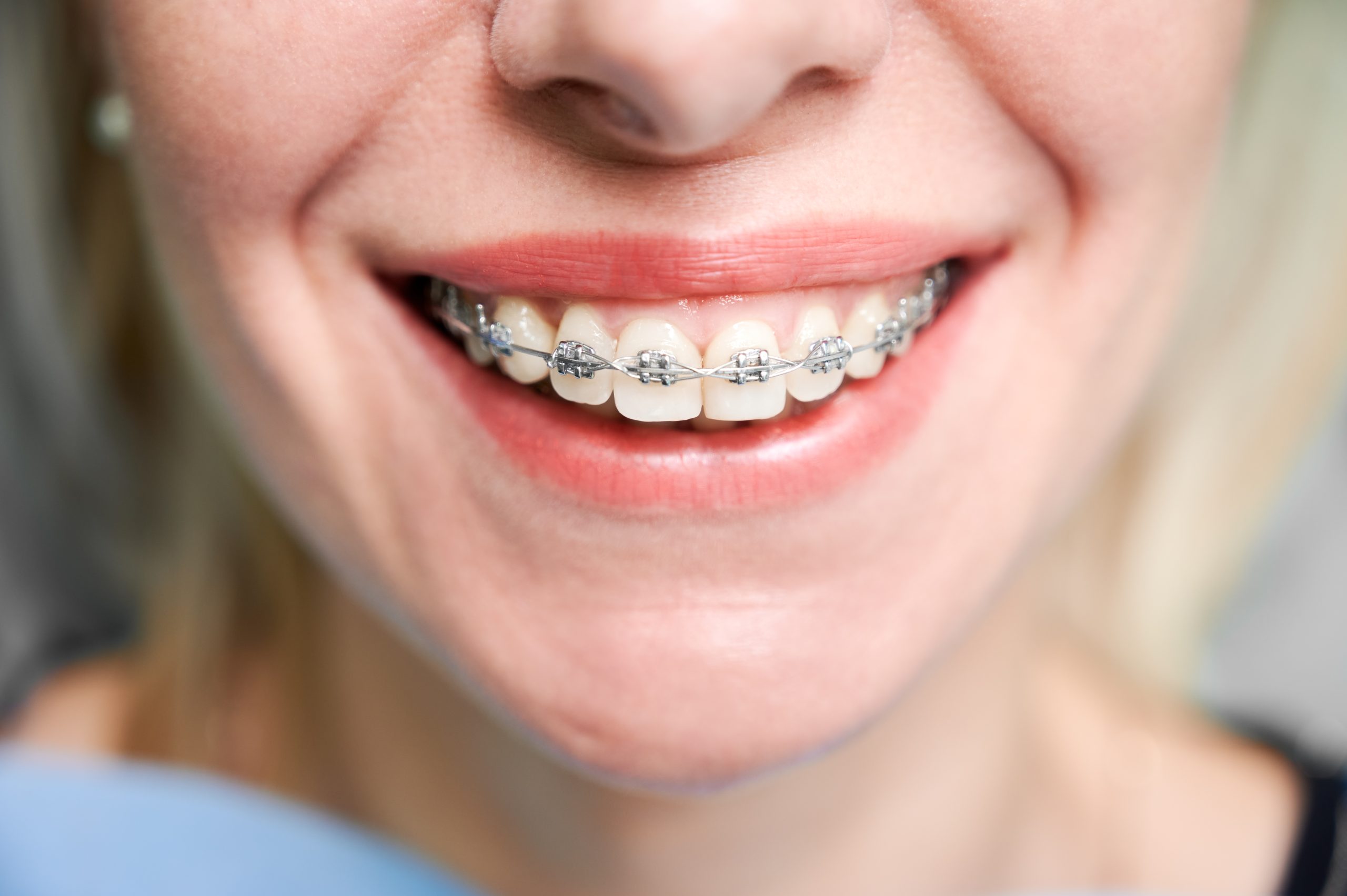 Ceramic Braces in Turramurra: Clear Braces for a Subtle Look